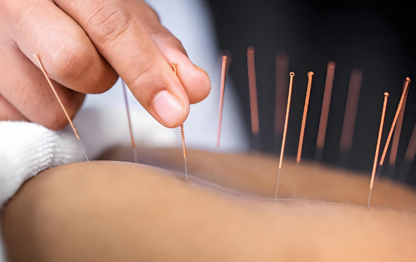 ACUPUNCTURE